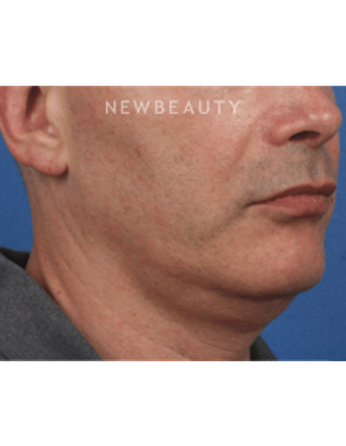 Dr. Julie Russak - Kybella - Before