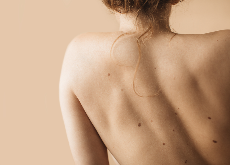 How to Conduct an At-Home Skin Cancer Screening, According to Dermatologists