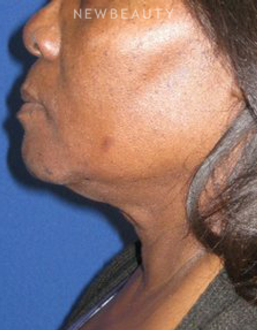 Dr. Dilip D. Madnani – Facelift - Before