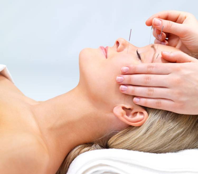 Acupuncture