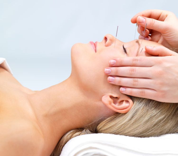 Acupuncture