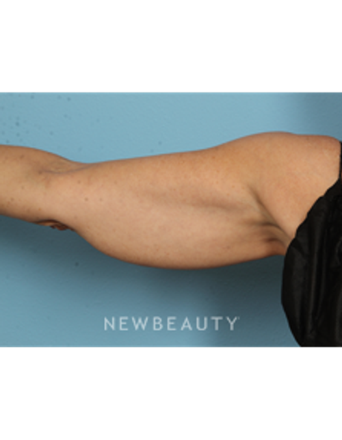 Dr. Kathleen Behr - CoolSculpting - Before