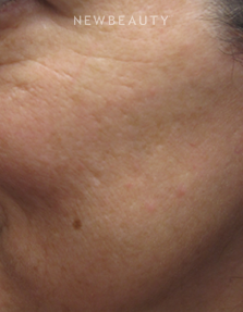 Dr. Jody Levine - Lasers - Before