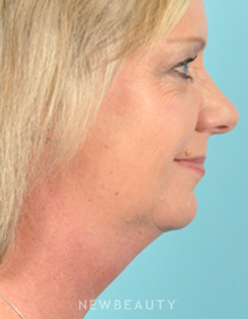 Dr. Bradley Bengtson - Kybella - Before
