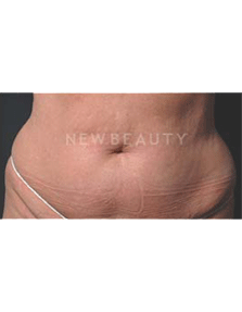 Dr. Ruth Hillelson Coolsculpting by Zeltiq - After