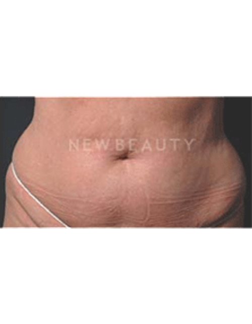 Dr. Ruth Hillelson Coolsculpting by Zeltiq - After
