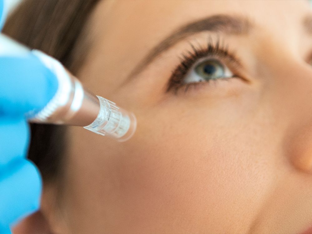 The Differences Between the Most Popular Radio-Frequency Microneedling Treatments