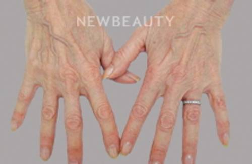 Dr. Doris Day - Radiesse and Fraxel - 8954030 - Before