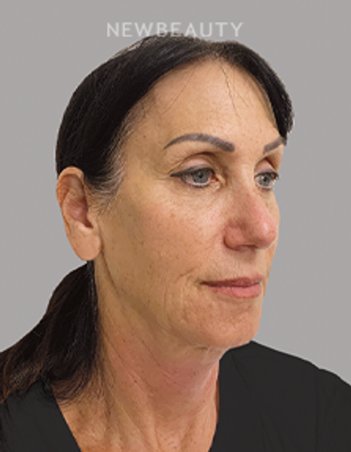Dr. Doris Day - Natural-looking Rejuvenation - 21597213 - After