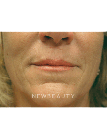Dr. Kenneth Beer Injectables & Fillers - After