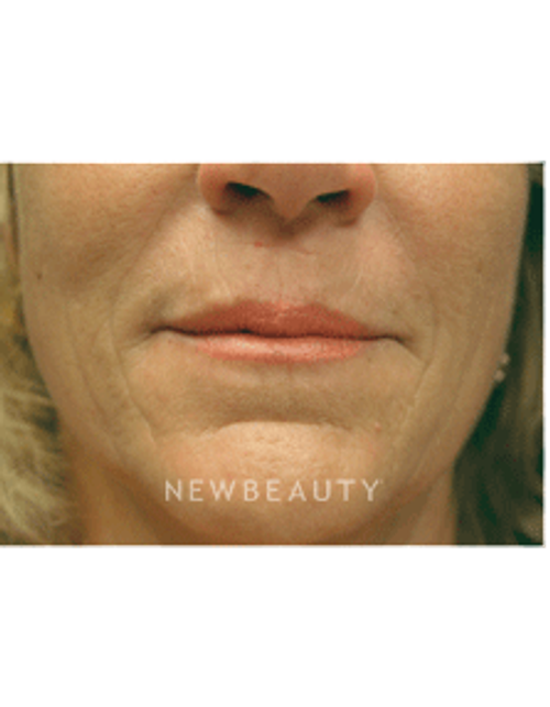 Dr. Kenneth Beer Injectables & Fillers - After