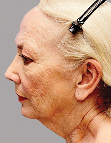 Dr. Paul Afrooz - Facelift - 34805495 - Before