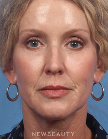 Dr. Kelly Bomer - Liquid Facelift - After