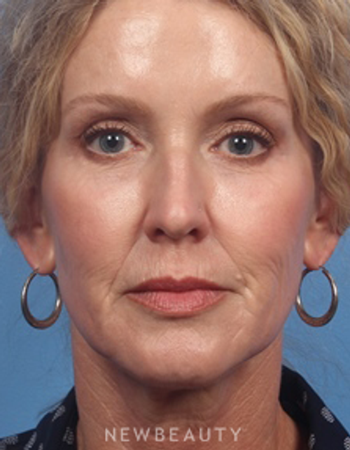 Dr. Kelly Bomer - Liquid Facelift - After