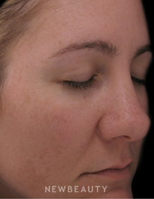 Dr. Kenneth Beer Lasers - After