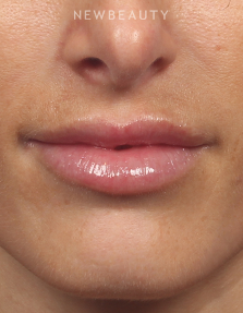 Dr. Kelly Bomer - Lip Filler - Before