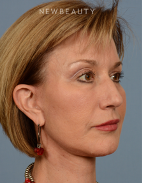 Dr. Bryan W. Gawley - Facial Rejuvenation - After