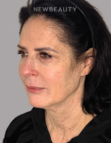Dr. Dilip Madnani - Facelift -  45284120 - Before