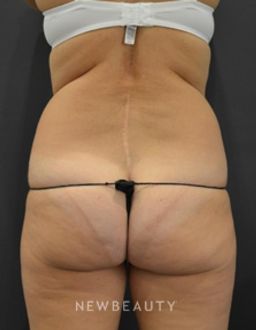 Dr. B. Aviva Preminger - Beautiful Contour - Before