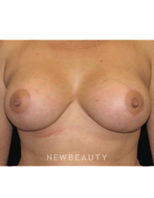 Dr. Sean Simon Breast Reduction, Breast Lift - After