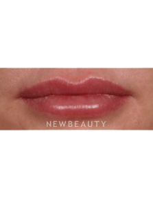 Dr. Kelly Bomer, Lip Enhancement - Before