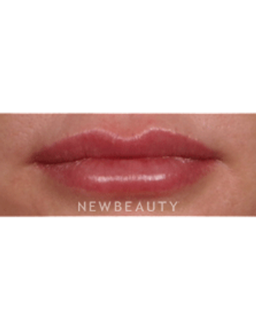 Dr. Kelly Bomer, Lip Enhancement - Before