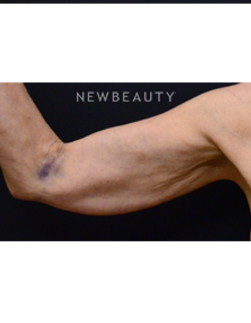 Dr. Mokhtar Asaadi - Arm Lift - Before