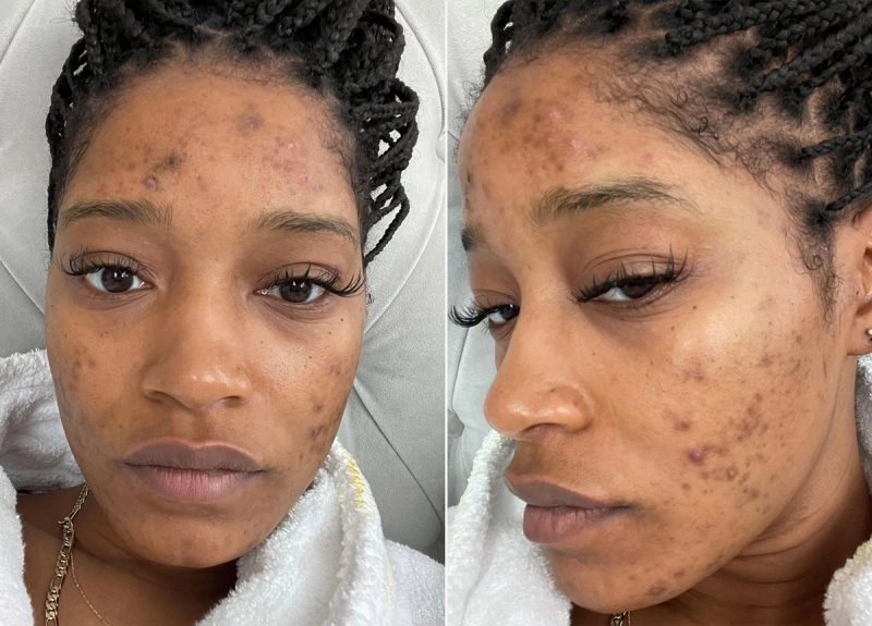 Keke Palmer Gets Real About Her Long-Time Struggle With Acne