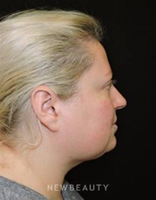 Dr. Joel Schlessinger - SmartLipo - After
