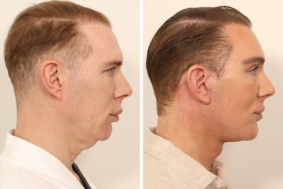 Kristofer Buckle facelift before and after