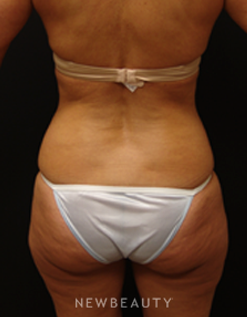 Dr. Mokhtar Asaadi Breast Augmentation, Vaser Liposelection, Tummy Tuck - Before
