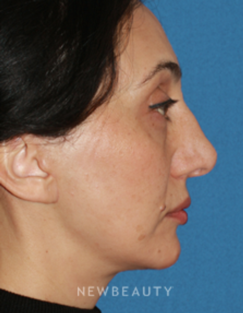 Dr. Konstantin Vasyukevich, Traditional Facelift - After