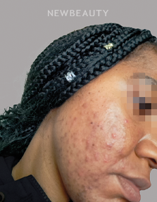 Dr. Anna Chacon - Acne - 34284242 - Before