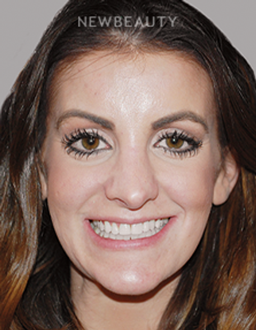 Dr. Salvator La Mastra - Smile Makeover -46108841 - Before