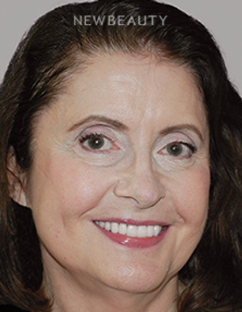 Dr. Salvator La Mastra - Smile Makeover -46108303 - After