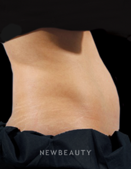 Dr. Marina Peredo - CoolSculpting - Before