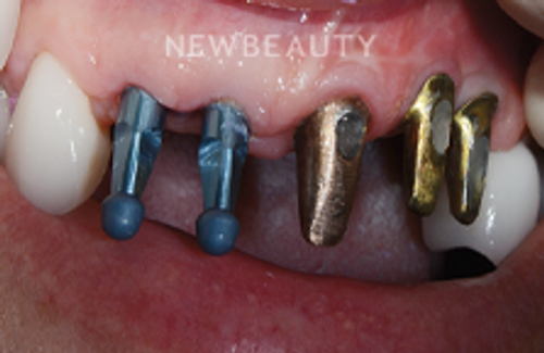 Dr. Hamid Atabakhsh - Dental Implants - 46426321 - Before