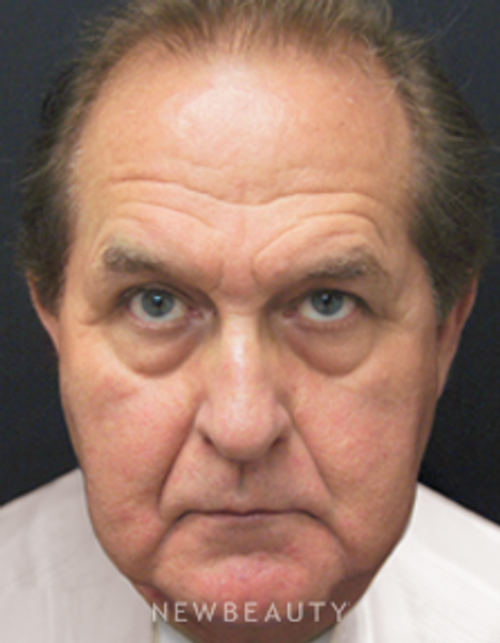Dr. Mokhtar Asaadi, Blepharoplasty, Traditional Facelift - Before