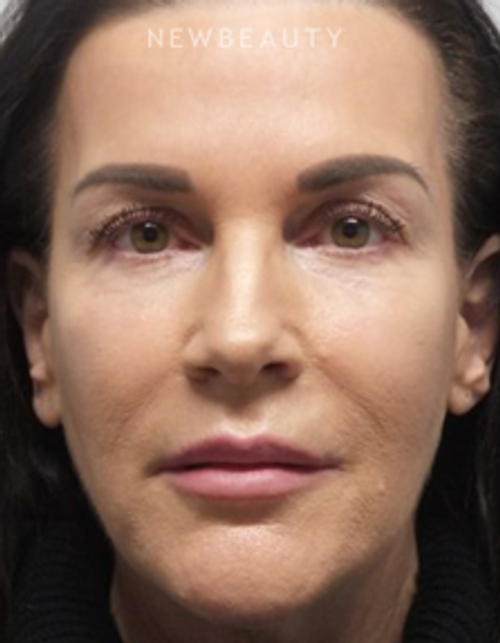Dr. Marina Peredo - Facelift - After