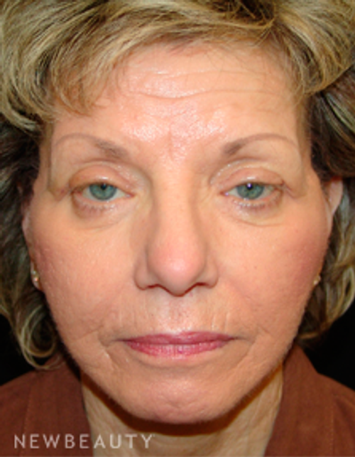 Dr. Mokhtar Asaadi Facelift, Eyelid Lift - After