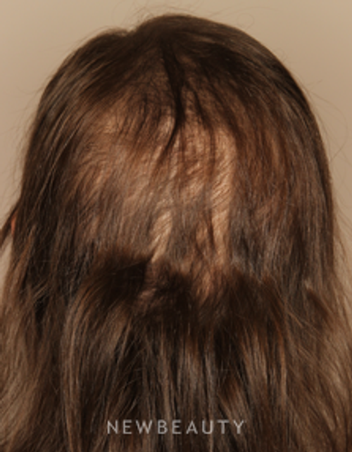 Dr. Doris Day - Hair Loss Treatment - Before