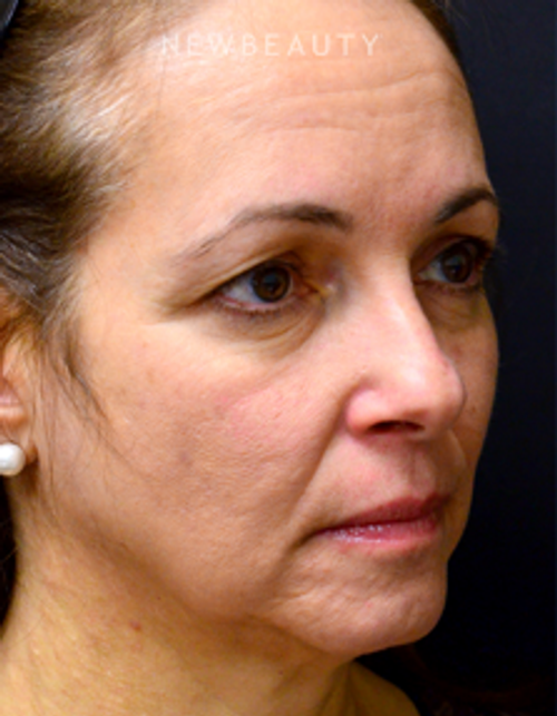 Dr. Mokhtar Asaadi - Browlift - Before