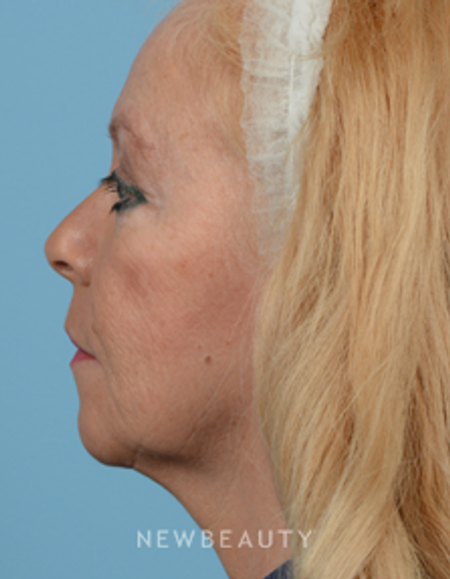 Dr. Jeffrey Wise - Facelift - Before