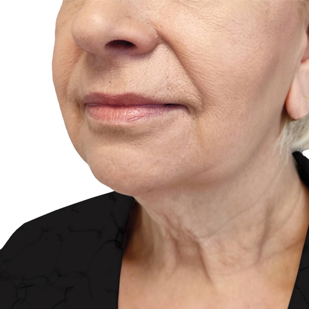 before deep-plane facelift and necklift