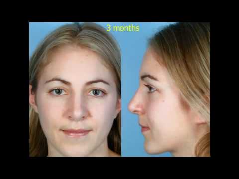 Dr. David Kim – Rhinoplasty – The Structural Approach To Rhinoplasty – Part 5