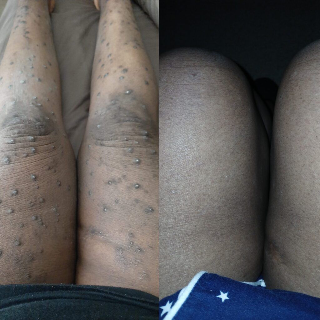 before and after prurigo nodularis