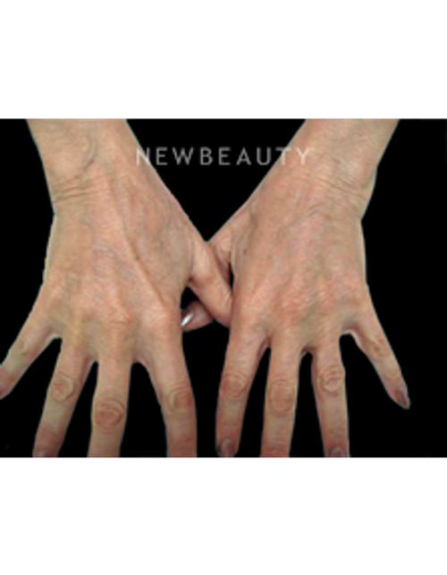 Dr. Doris Day - Reducing Wrinkles - After