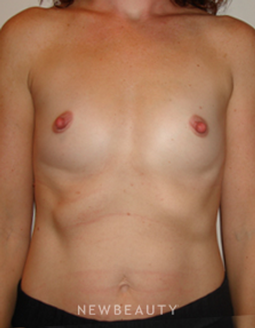 Dr. Michael Horn Breast Augmentation - Before