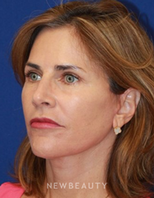 Dr. Dilip Madnani - Facelift - After