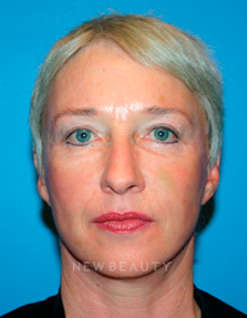 Dr. Kelly Bomer Liquid Facelift - After